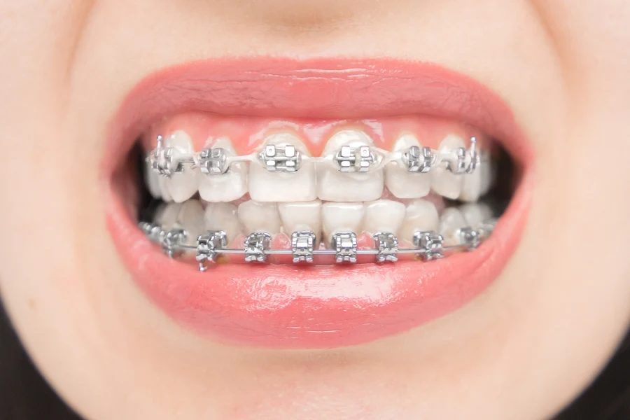 Ceramic Braces