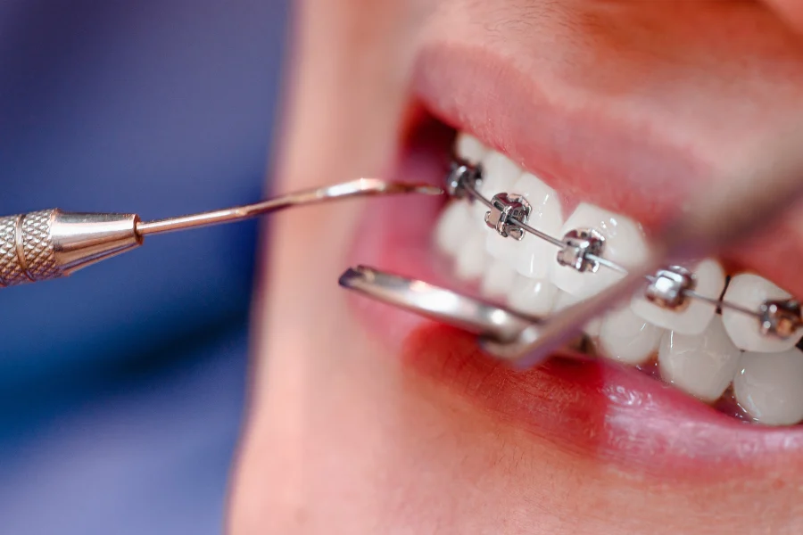 Traditional Metal Braces